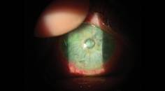 Microbial Infections in Contact Lens Wearers