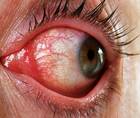 How to Handle Pink Eye
