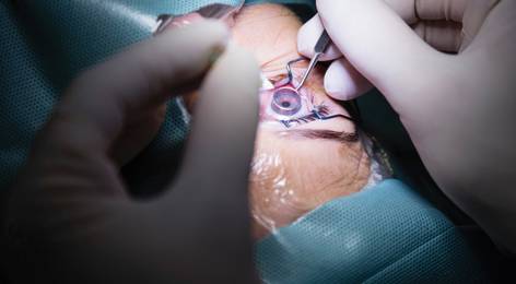 The Optometrist’s Guide to Fuchs Endothelial Corneal D...