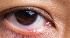 Understanding MGD Through the Lens of Sebaceous Gland Dysfunction