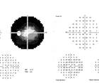 Visual fields amblyopia