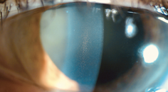 Pigmentary Dispersion Syndrome and Pigmentary Glaucoma