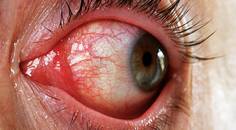 How to Handle Pink Eye