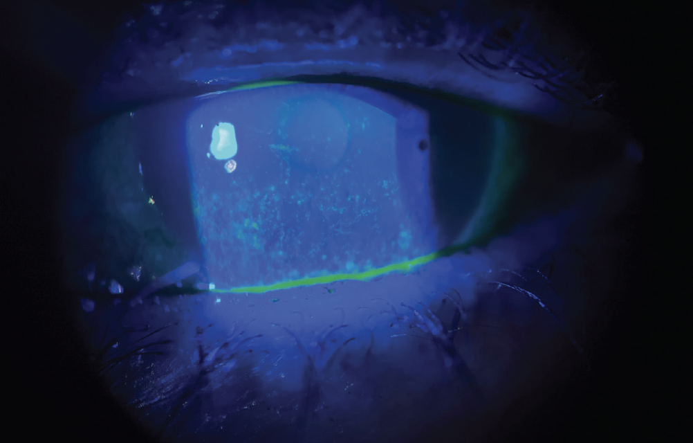 Prepping the Ocular Surface Before Cataract Surgery Referral
