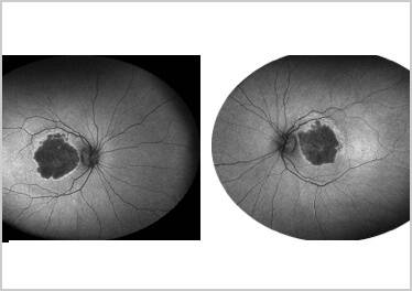 GA Case Compendium Image Findings Suggesting Risk of Geographic Atrophy Progression