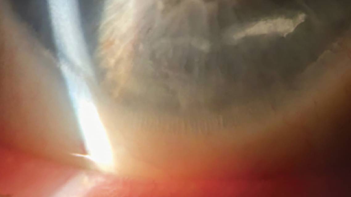 The Skinny on Salzmann Nodular Degeneration