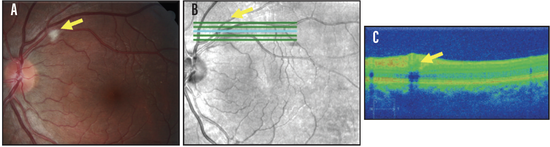Retinal Imaging in Hematologic Disorders
