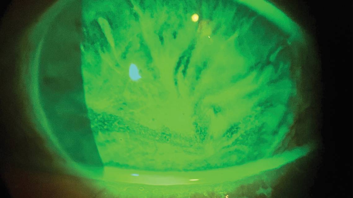 Limbal Stem Cell Deficiency