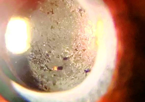 IOL Opacification