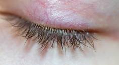 When Is Dry Eye More Than Just Dry Eye