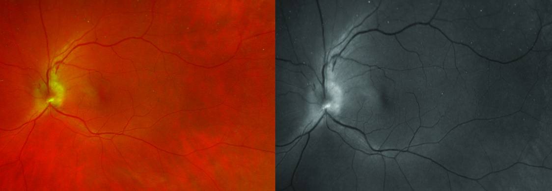 Fundus photography showed superior optic nerve edema OS with a normal and red free filter