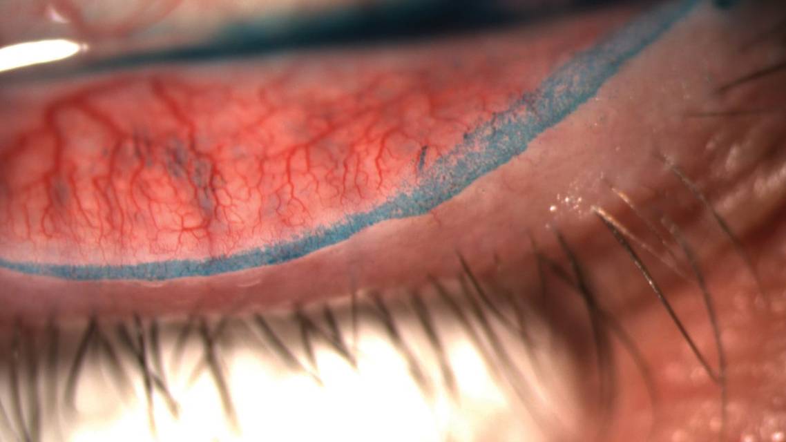 Putting a Lid on Epitheliopathy