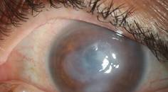 Mycobacterial Ocular Infections