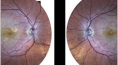 GA Case Compendium The Optometrist as Advocate for the Patient with Geographic Atrophy