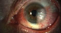 Key Identifiers in Cancerous Conjunctival Lesions