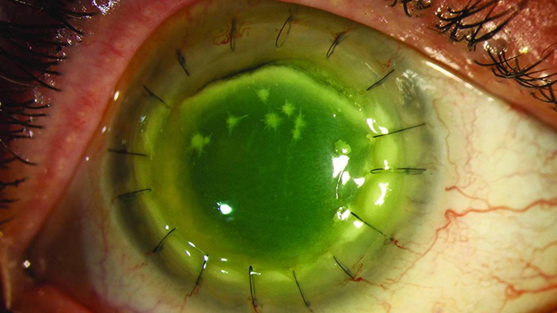 Infectious Crystalline Keratopathy