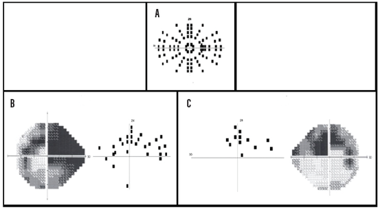 A New Era in Visual Field Testing