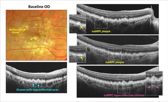 GA Case Compendium: Identifying High-Risk Biomarkers for