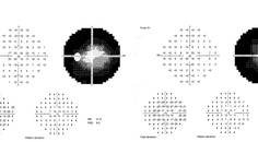 Visual fields amblyopia