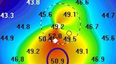 Collaborative Case 009 Two Cases of Keratoconus