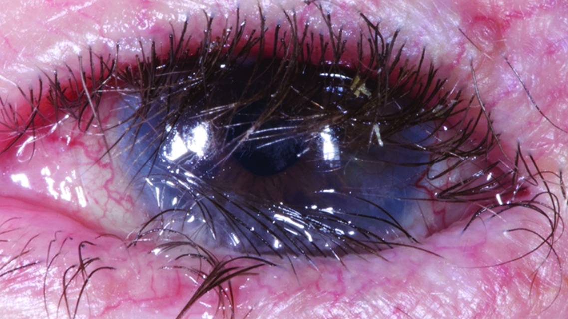 Ocular Cicatricial Pemphigoid