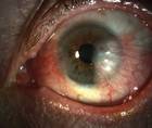 Key Identifiers in Cancerous Conjunctival Lesions