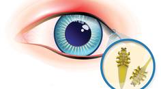 Demodex Friend or Foe