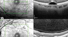 MEK Inhibitors and the Eye
