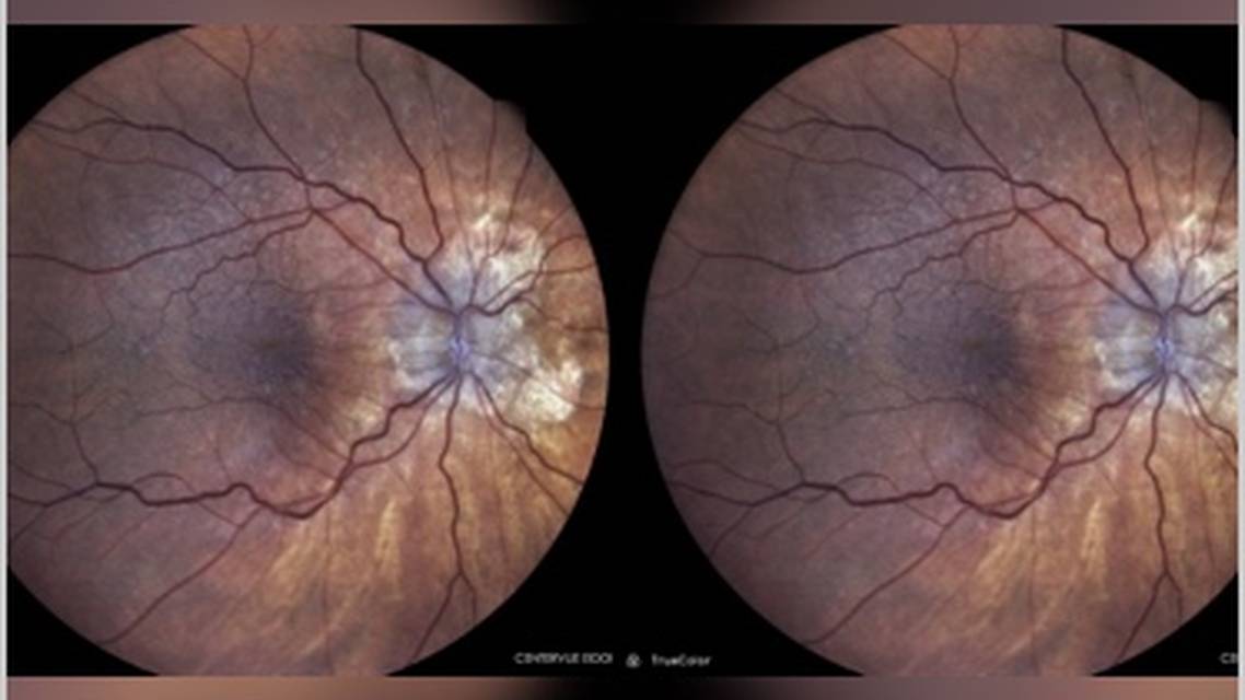 GA Case Compendium Collaborative Care to Improve Patient Adherence to Therapy