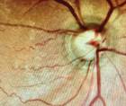 Optic Nerve Hemorrhages and Glaucoma