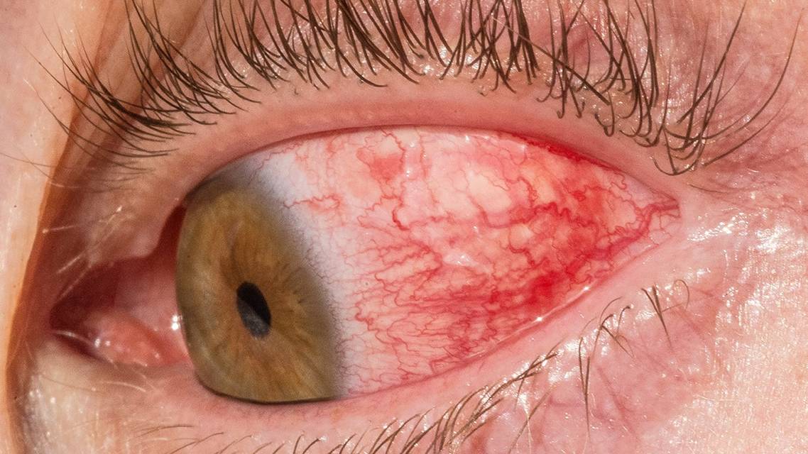 Not Your Typical Scleritis