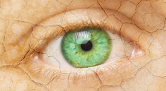 Use of Scleral Lenses For Dry Eye Disease