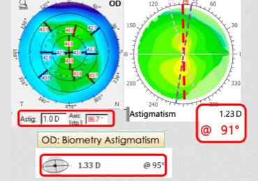 Collaborative Case 010 Managing the Unhappy Presbyopic IOL Patient