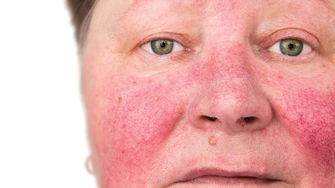 A Basic Guide to Ocular Rosacea