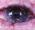 Ocular Cicatricial Pemphigoid