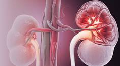 Ocular Complications of Renal Cancer