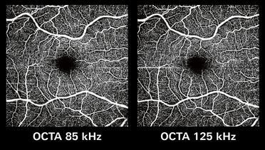 Heidelberg Engineering Introduces Faster OCT Angiography with Spectralis Shift Technology image