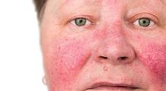 A Basic Guide to Ocular Rosacea