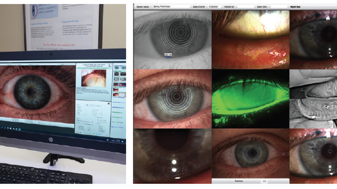 Dry Eye Story Maximizing Workflow Implementing Advanced Technologies Finding Fulfillment
