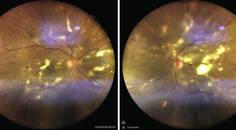 retina image