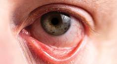 When Blepharitis InterferesWith Contact Lens Wear