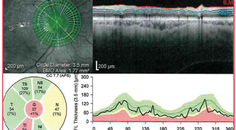 OMNI in Standalone Pseudophakic Patients