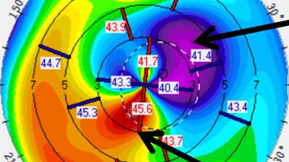 Collaborative Case 008 IOL Selection Challenge