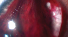 Hyphema