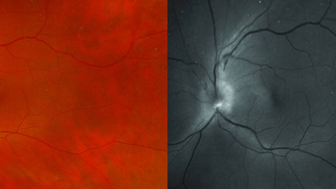 Fundus photography showed superior optic nerve edema OS with a normal and red free filter
