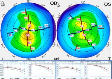 Collaborative Case 011 Treating Irregular Astigmatism After Laser Vision Correction