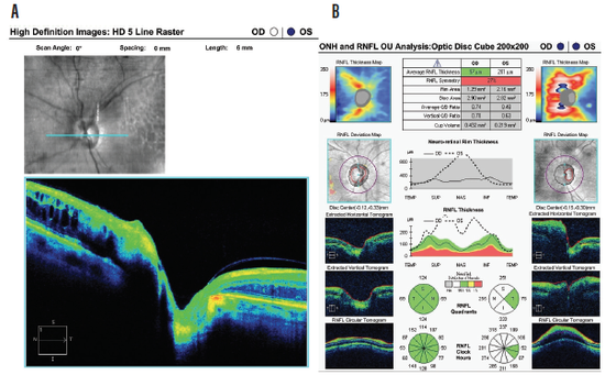 Radiation-Induced Optic Neuropathy After Choroidal Met...