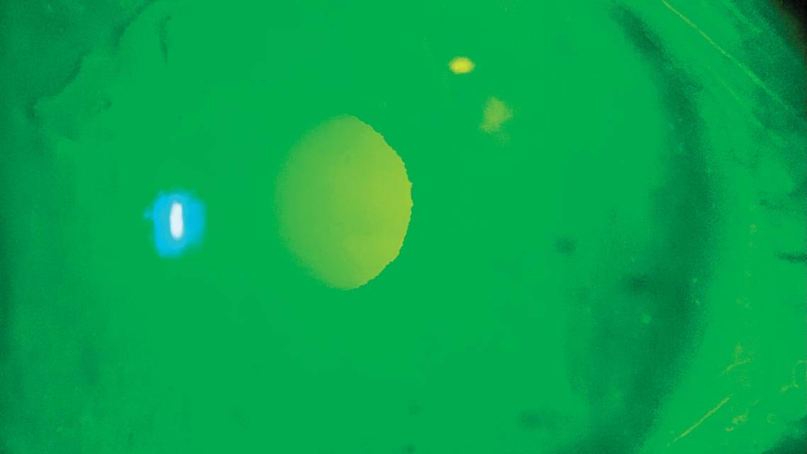 Treatment Options for RCE