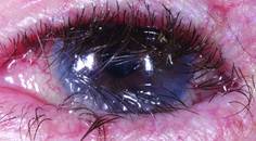 Ocular Cicatricial Pemphigoid