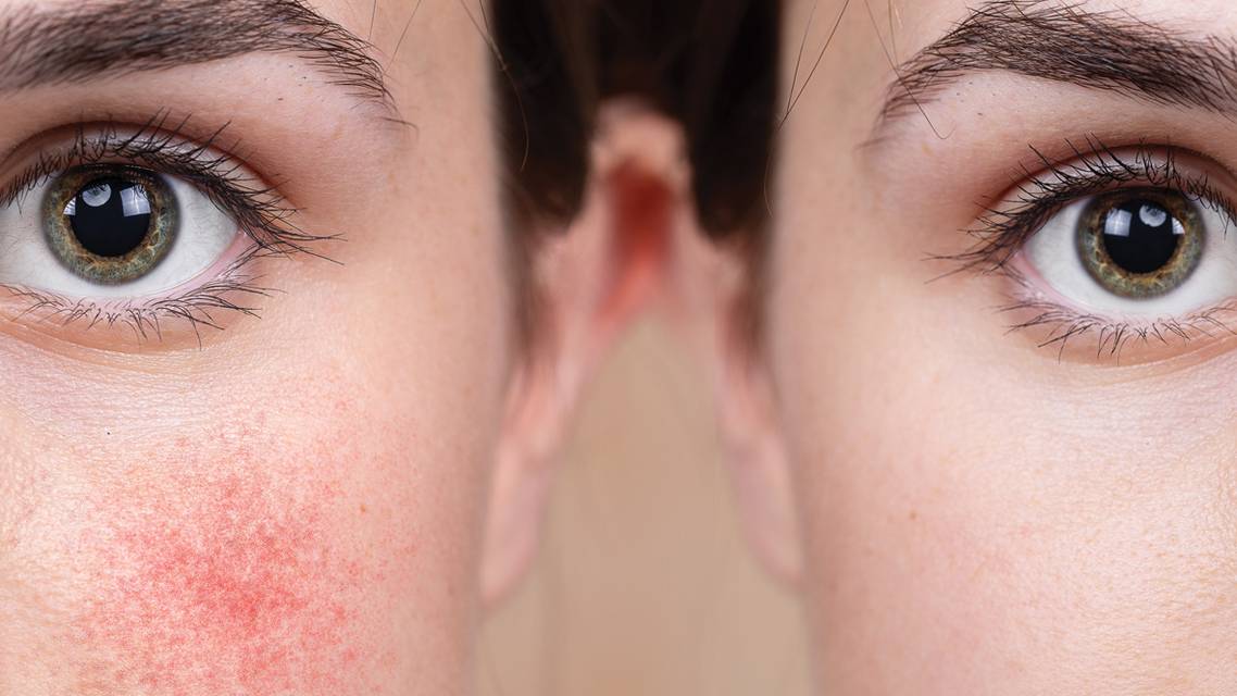 IPL Therapy and Ocular Rosacea